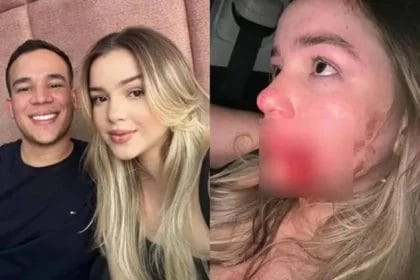Em suas redes sociais, ela compartilhou fotos do rosto ensanguentado e marcado pela violência. Foram feitos, ao todo, cinco pontos na regulação do rosto. © Reprodução- Instagram