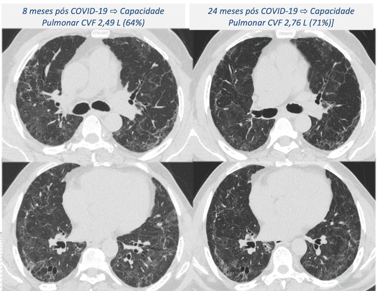 Estudo aponta que sequelas pulmonares podem se agravar até dois anos após internação por COVID-19 severa